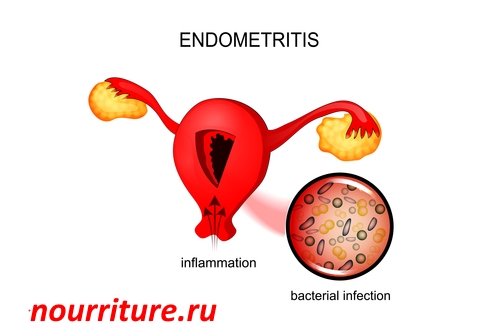 Endometritis.jpg