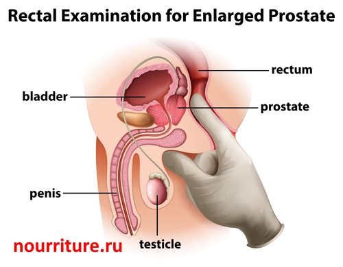 Prostata-cancer1.jpg