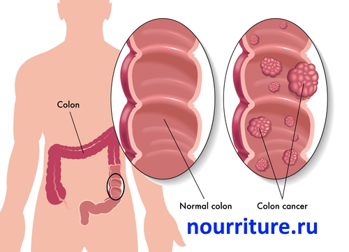 Colon-cancer1.jpg